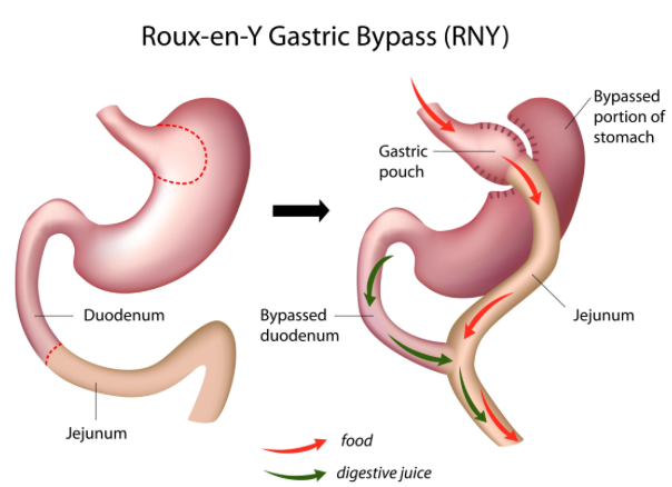 Gastric bypass