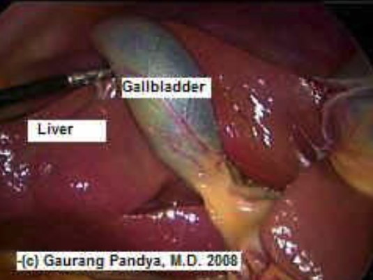 gallbladder_diagram