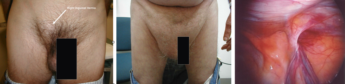 Hernia surgery - Sydney Obesity Centre